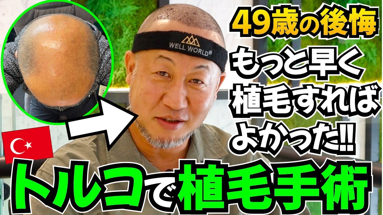【髪の毛】後悔してる、もっと早く植毛すれば良かった!! 【自毛植毛｜薄毛対策】