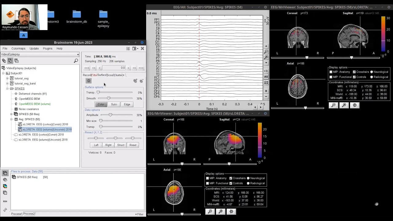 EEG source imaging of epilepsy recordings using Brainstorm