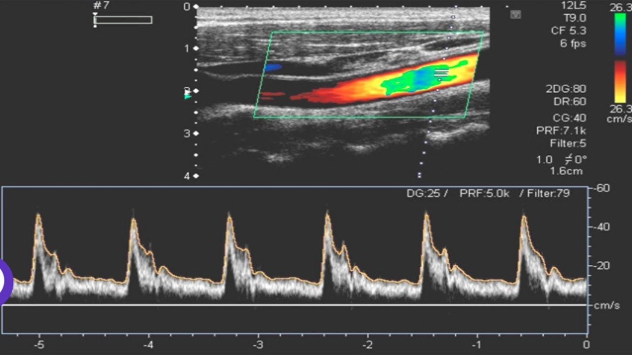 Power Doppler Ultrasound &ndash; High-Sensitivity Blood Flow Imaging and Signal Analysis