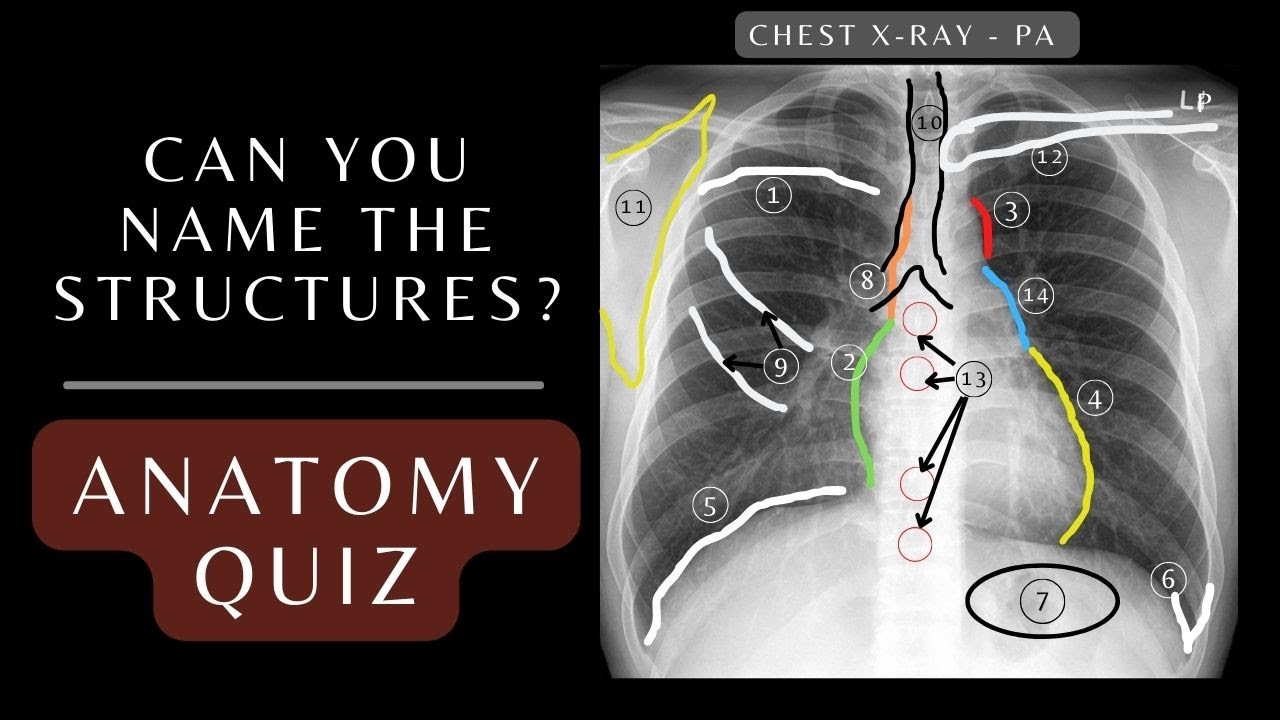 Chest X-ray Anatomy Quiz: Questions and Answers | Chest X-ray Anatomy #xray #respiratory