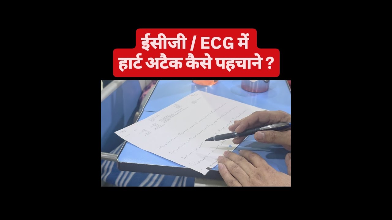 #heartattack #heartattacksymptoms #STElevation #ECGFindings #TroponinT #CAG #ecg #hearthealth #neet