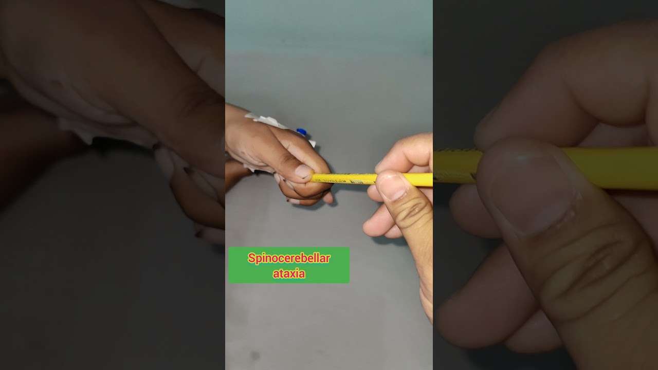 Intention Tremors in a female patient with spinocerebellar ataxia. #intentiontremors #ataxia
