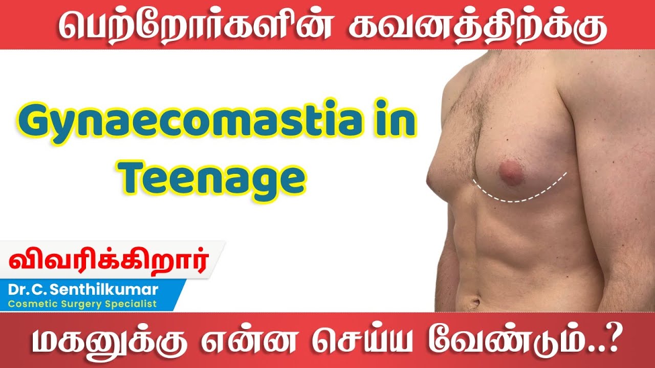 Gynecomastia in teenage | அறுவை சிகிச்சை தேவையா ? | Dr.C. Senthil Kumar | Gynecomastia in Coimbatore