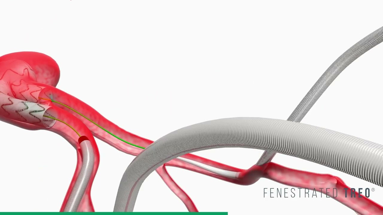 Fenestrated TREO   Deployment Animation