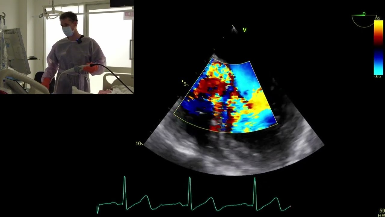 Live scan (TOE):  severe aortic regurgitation, bicuspid valve, ?infective endocarditis