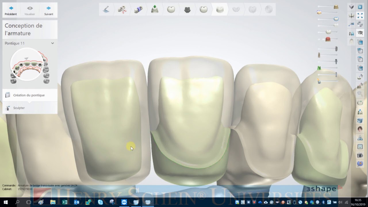 Bridge transvissée avec gencive 3Shape