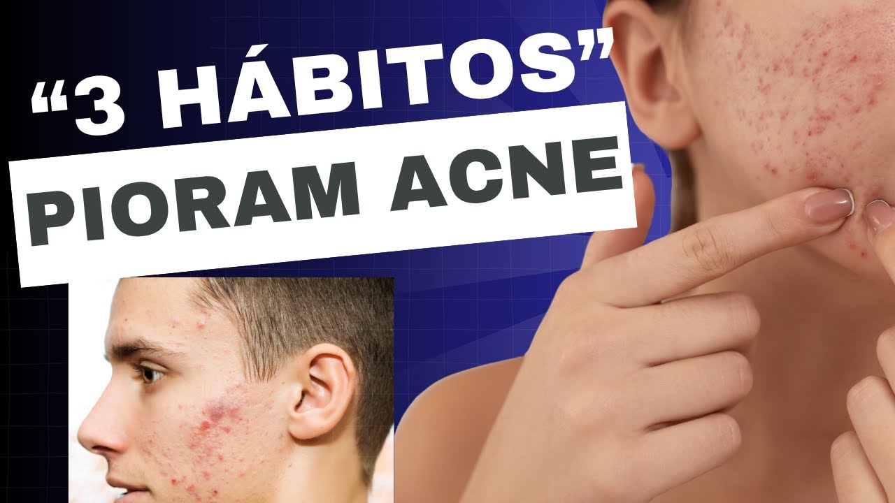 3 HÁBITOS QUE PIORAM SUAS ESPINHAS [DERMATO EXPLICA]