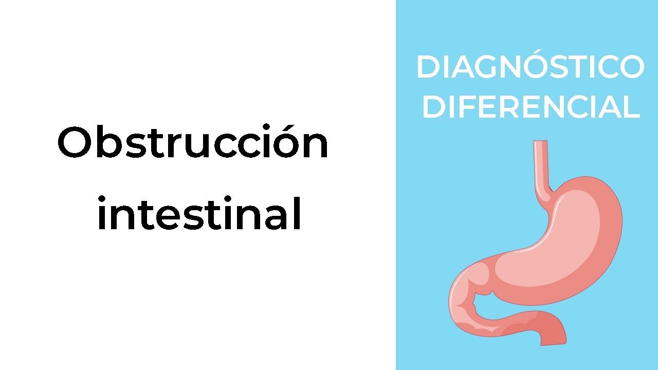 Diagnóstico Diferencial. Obstrucción intestinal