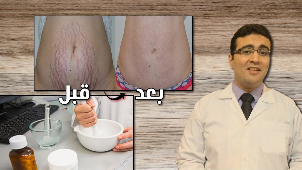 الخلطة اللي هتخلصك من الاسترتش ماركس!