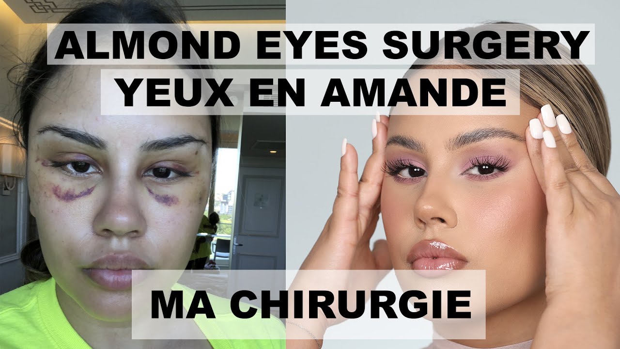 MA CHIRURGIE DES YEUX EN AMANDE / BELLA EYES & ALMOND EYES / PONYTAIL LIFT /