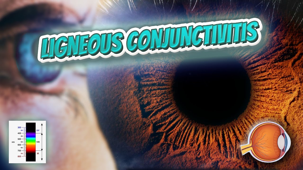 Ligneous conjunctivitis (Your EYEBALLS) 👁️👁️💉😳💊🔊💯✅