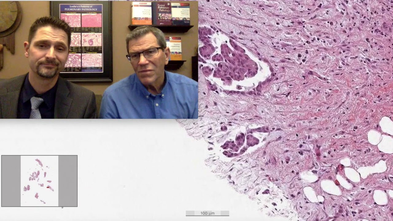 Pattern 5 &ndash; Nodules, Malignant Mesothelioma (Top 25 Pearls Series, Topic 5, Pearl 1)