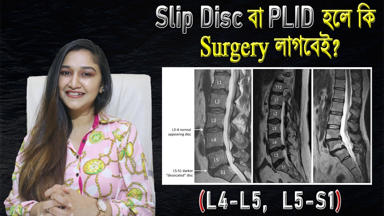 Slip Disc বা PLID হলে কি Surgery লাগবেই? (L4 - L5, L5 - S1) কী? Umma Salma Urmy