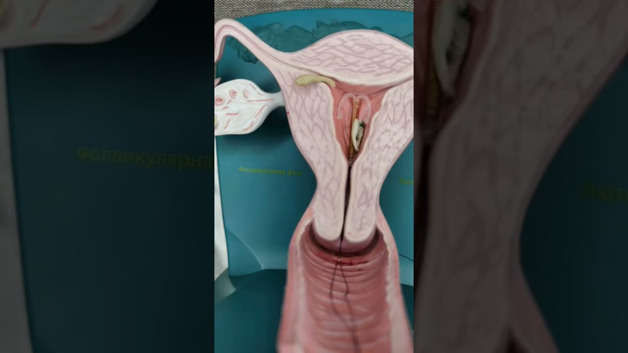 Как работает внутриматочная спираль. #shorts #гинеколог #контрацепция #спираль