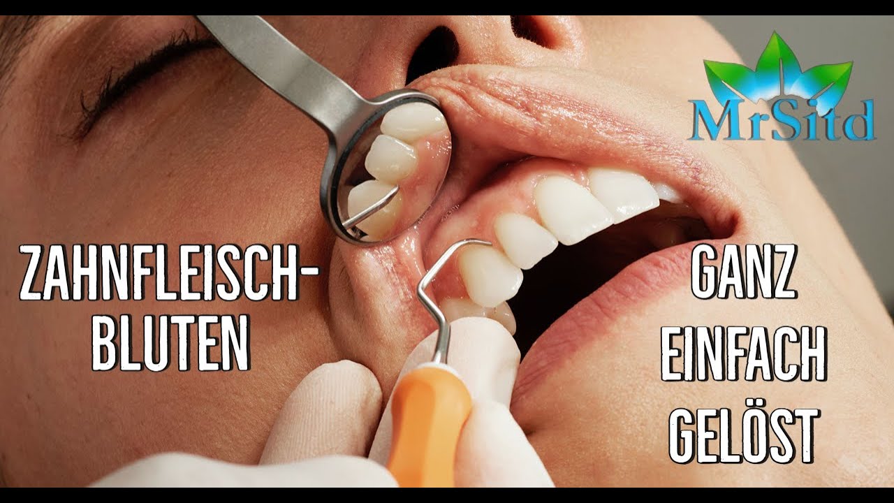chronisches Zahnfleischbluten - alternativ behandeln