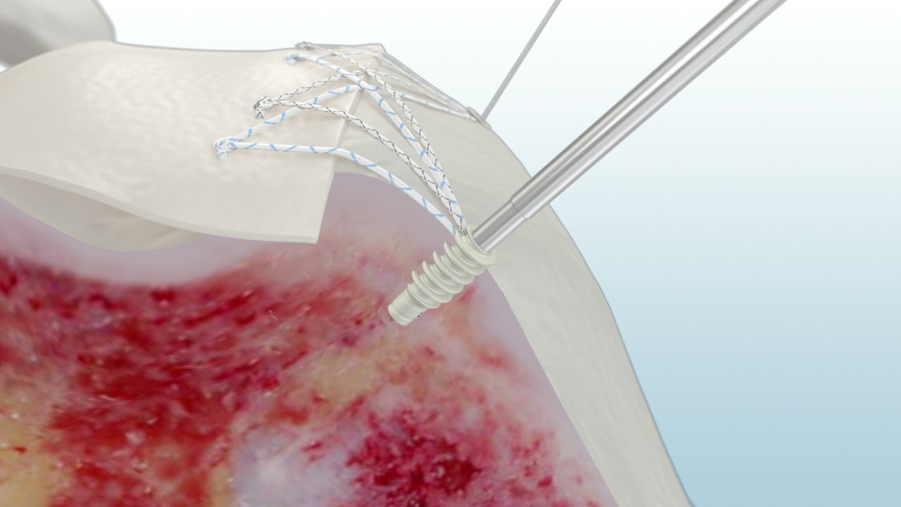 MEDHOLD scr using y knot pro flex with ribbon y knot pro rc with ribbon crossft knotless dt