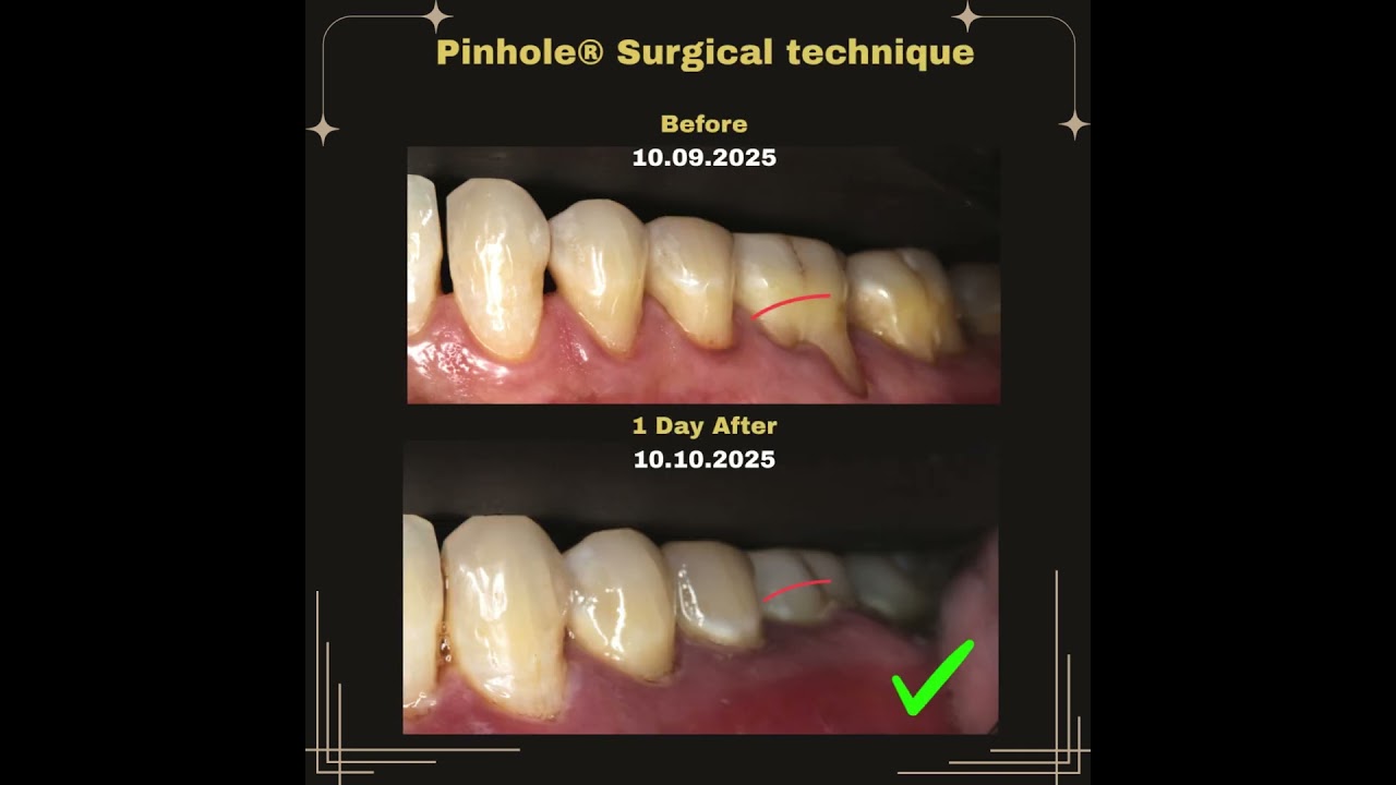 1 Day After Pinhole&reg; Surgery &mdash; Instant Gum Renewal! 🌿✨