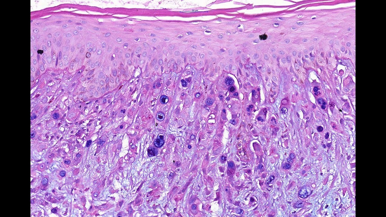 Metastatic Signet ring cell carcinoma Phillip McKee Antonina Kalmykova CSD Health Care Kyiv
