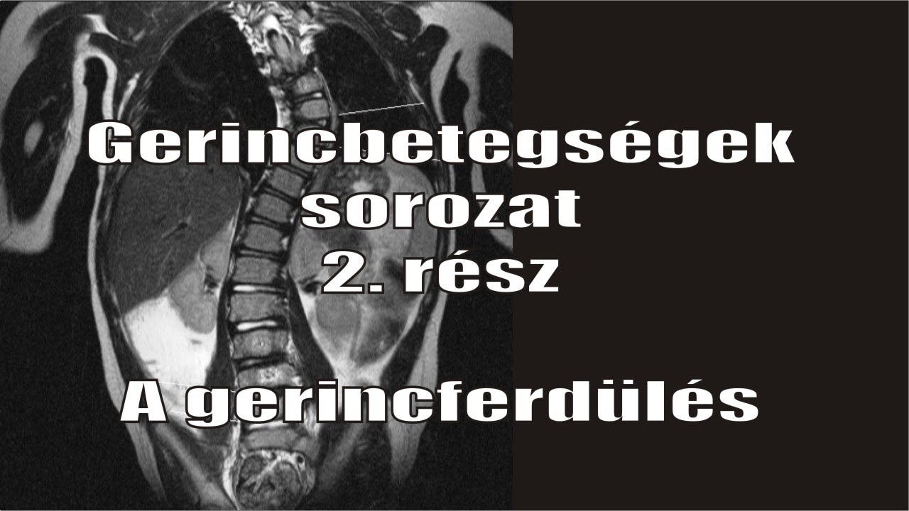 Gerincbetegségek sorozat 2. rész: A gerincferdülés