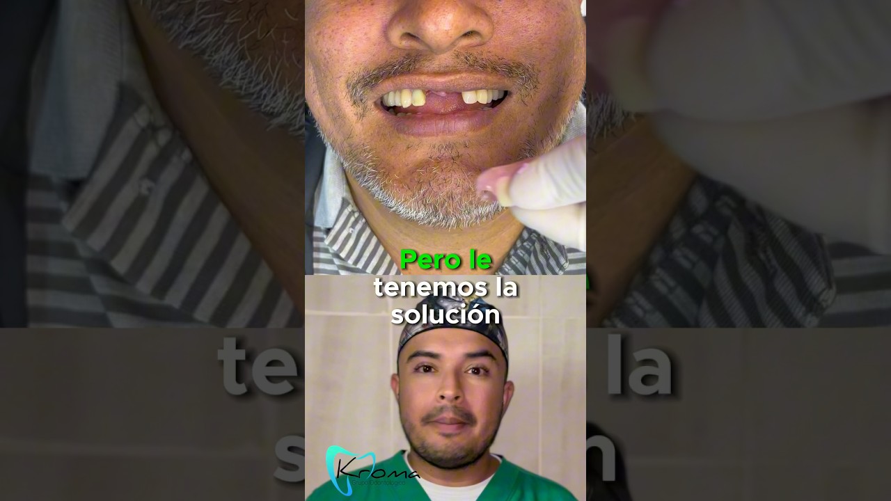 &iexcl;Sonr&iacute;e con confianza! Descubre las pr&oacute;tesis dentales tipo Acker, la soluci&oacute;n r&aacute;pida y econ&oacute;mica