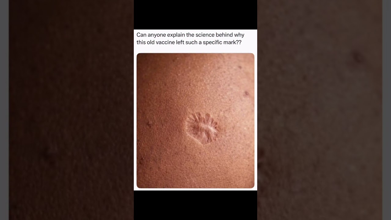 The Scar Millions of People Have and Don't Know Why...
