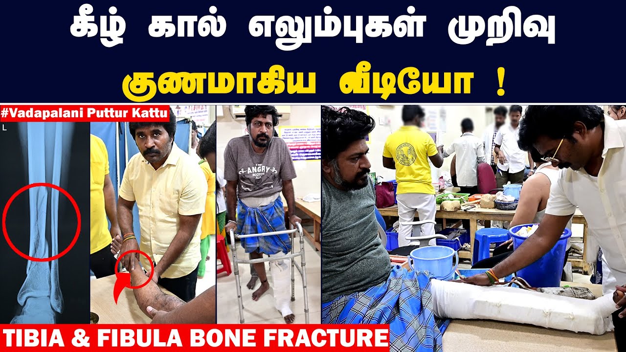 கீழ்கால் எலும்புகள் முறிவு குணமாகிய வீடியோ | Tibia & Fibula Bone Fracture | வடபழனி புத்தூர் கட்டு