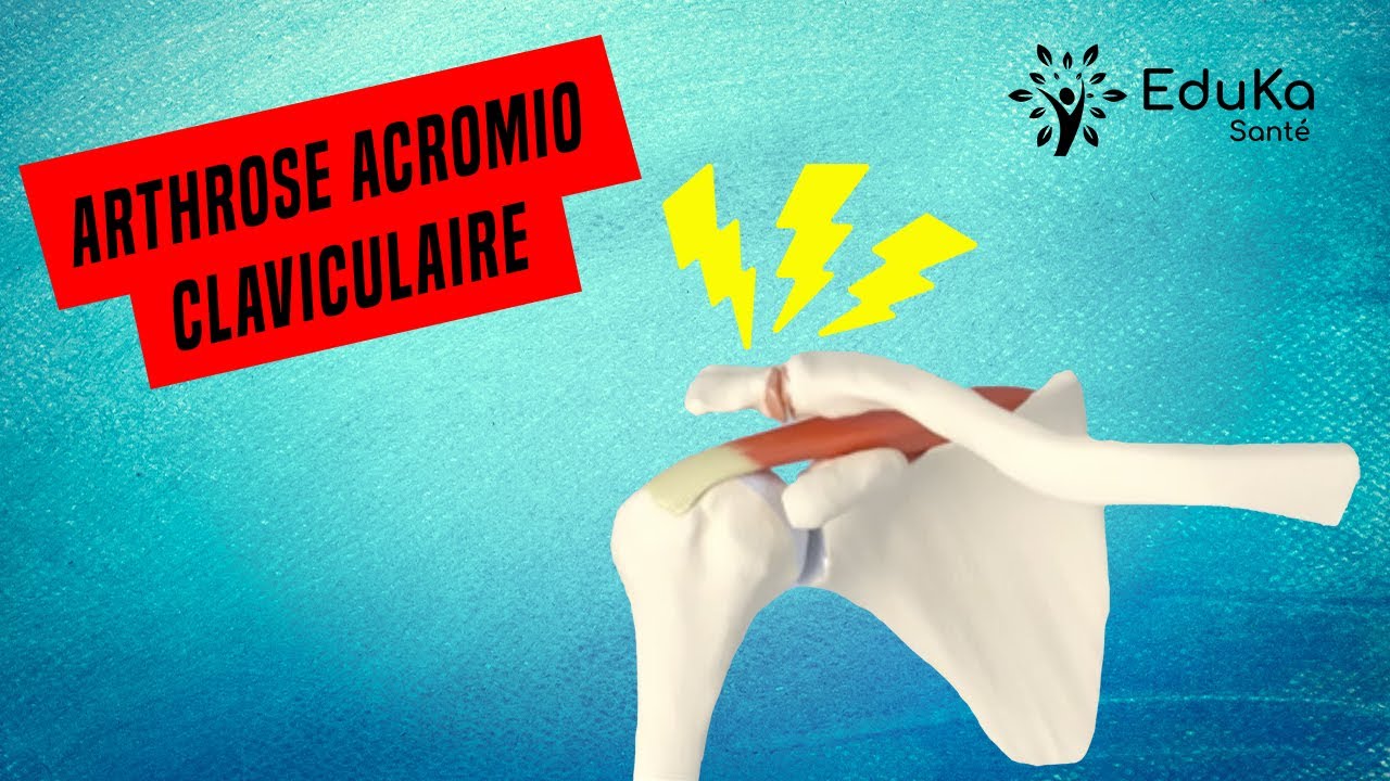 COMPRENDRE L'ARTHROSE ACROMIO CLAVICULAIRE