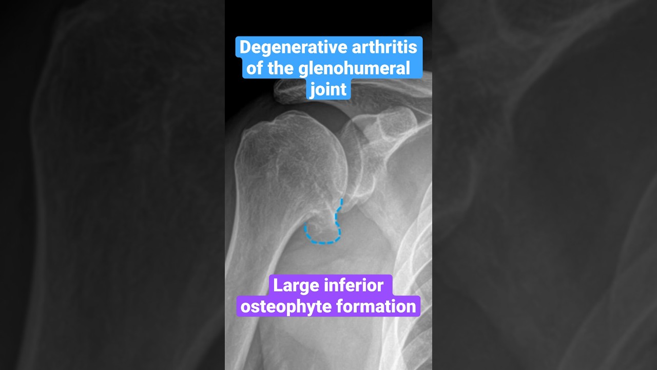 Degenerative Arthritis (DJD) of the Shoulder