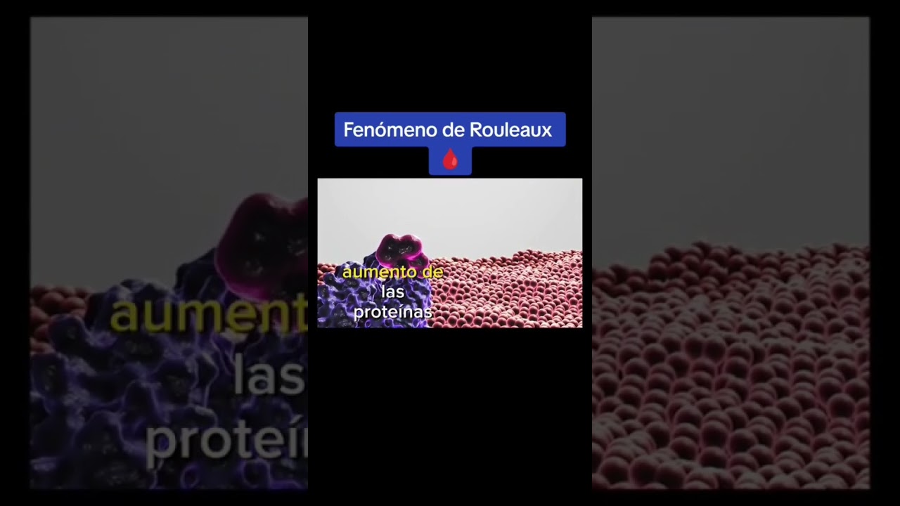 Fen&oacute;meno de Rouleaux en &eacute;l laboratorio cl&iacute;nico