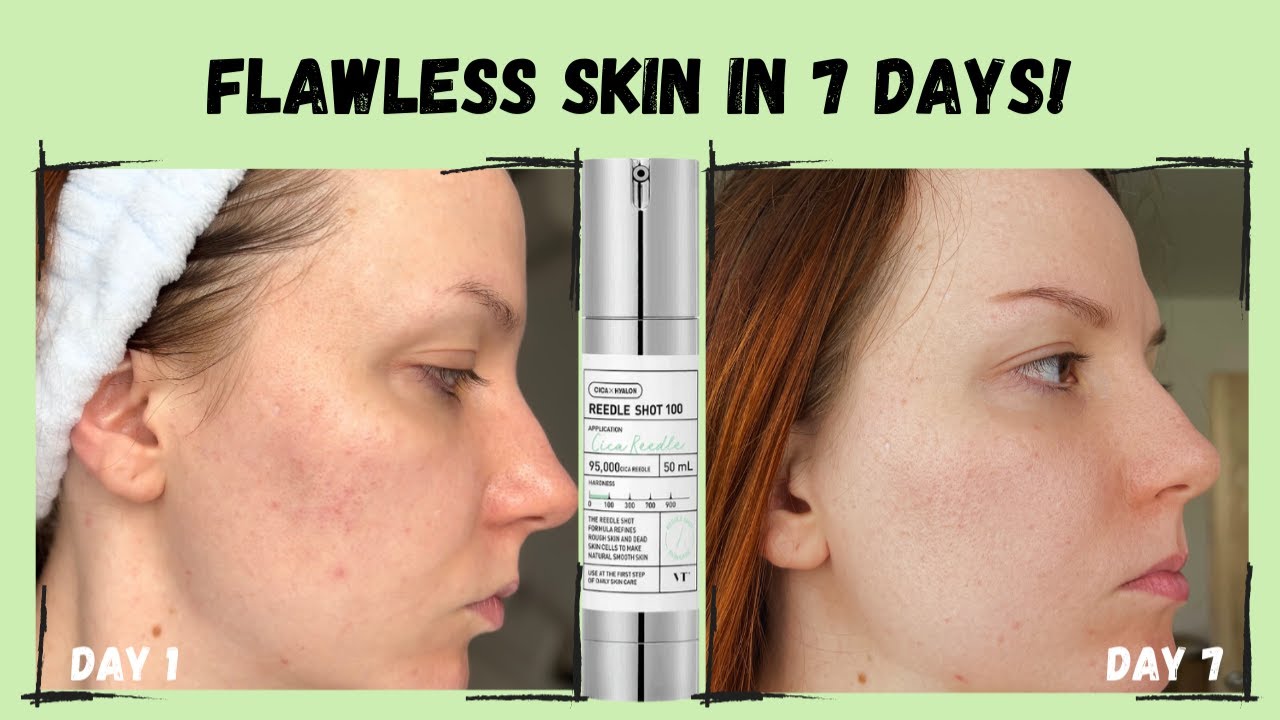VT Cica Reedle Shot - DID IT FIX MY SKIN? | 7 day test