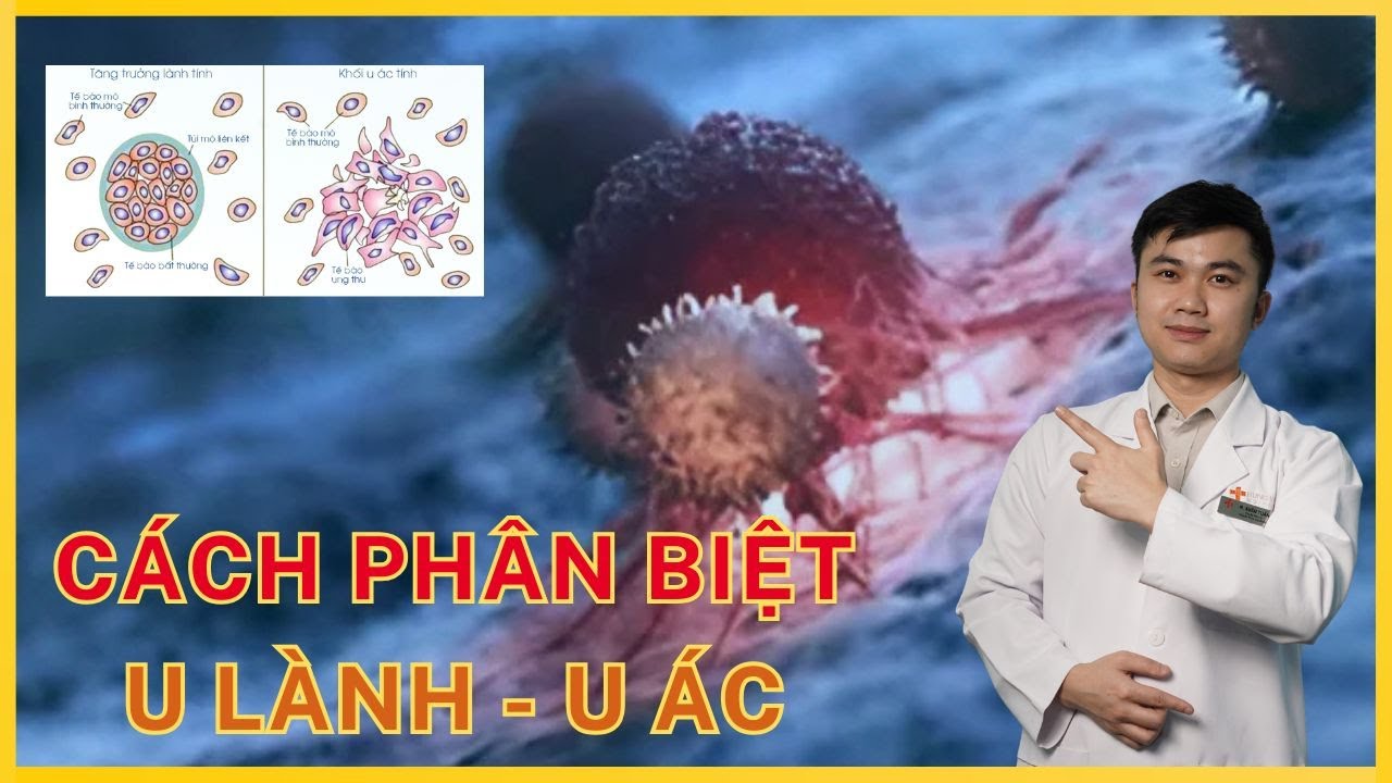 U lành nhưng vẫn nguy hiểm nếu bạn bỏ qua điều này! | BS Xuân Tuấn ung bướu