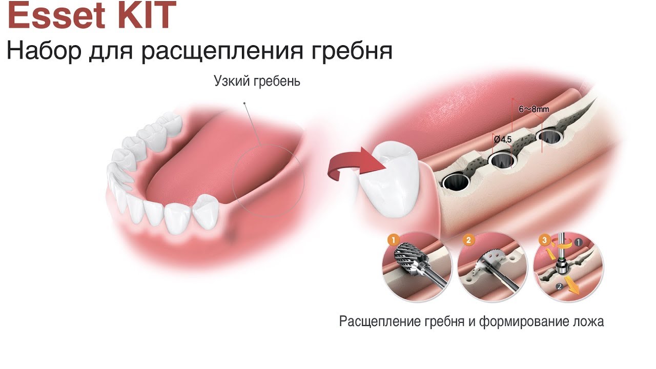 Esset KIT. Набор для расщепления гребня