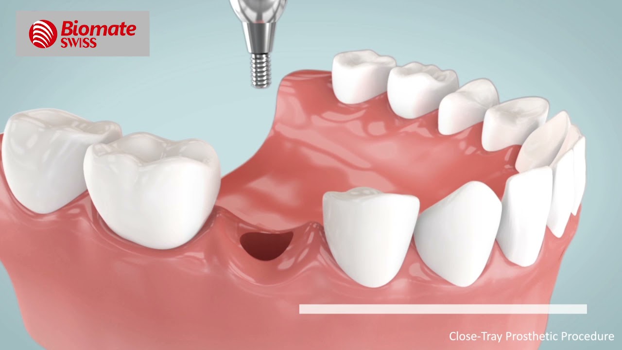 BiomateSWISS | How to take close tray impression