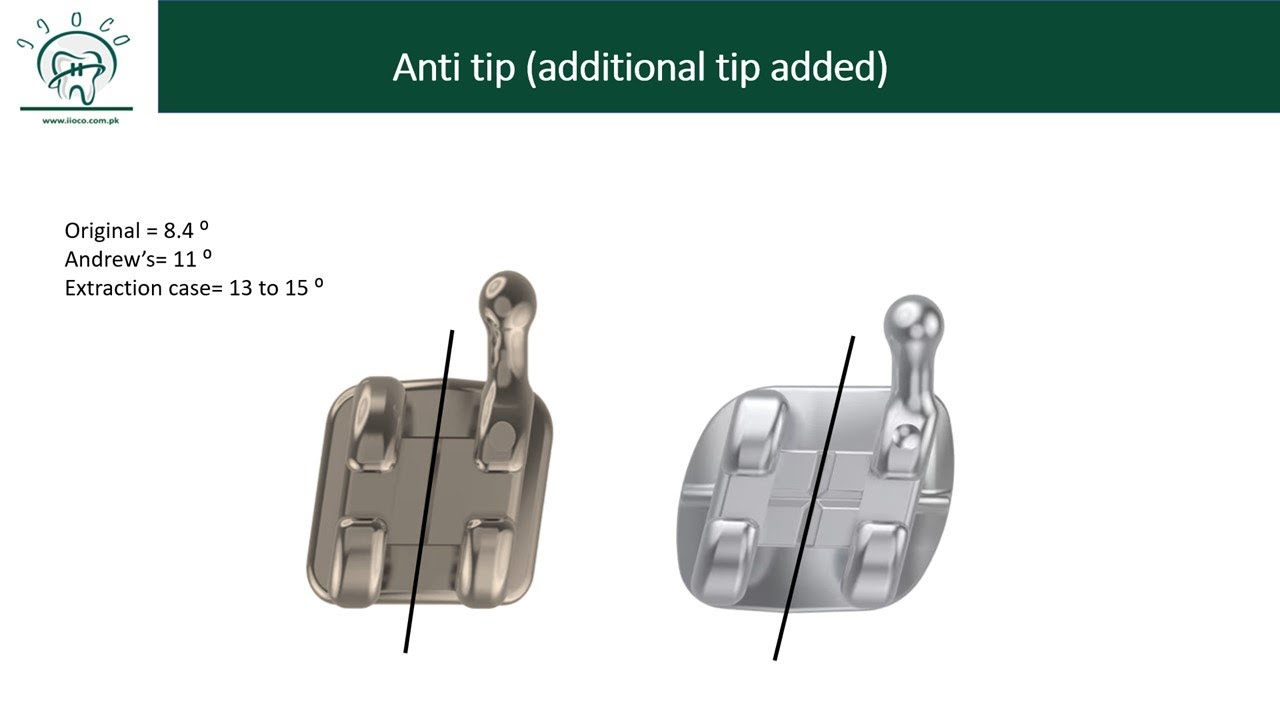 Andrew's Bracket Prescriptions in Fixed Appliances