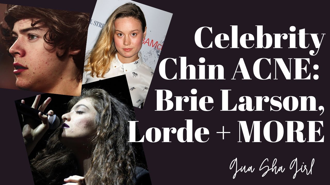 Celebrity Chin Acne: Brie Larson, Lorde and MORE! How To Treat Acne According To Face Mapping