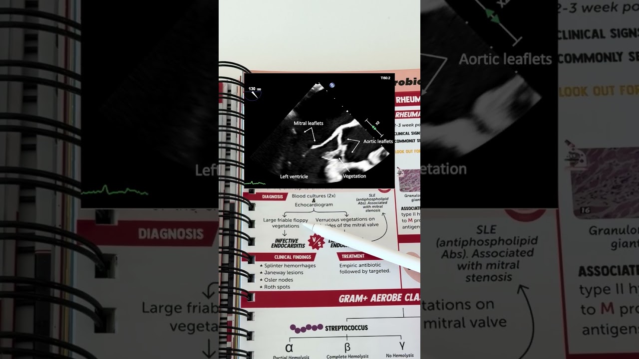 День 1/30: Инфекционный эндокардит 🦠🫀#usmle #usmlestep1 #medstudent #medschool #medicalstudent