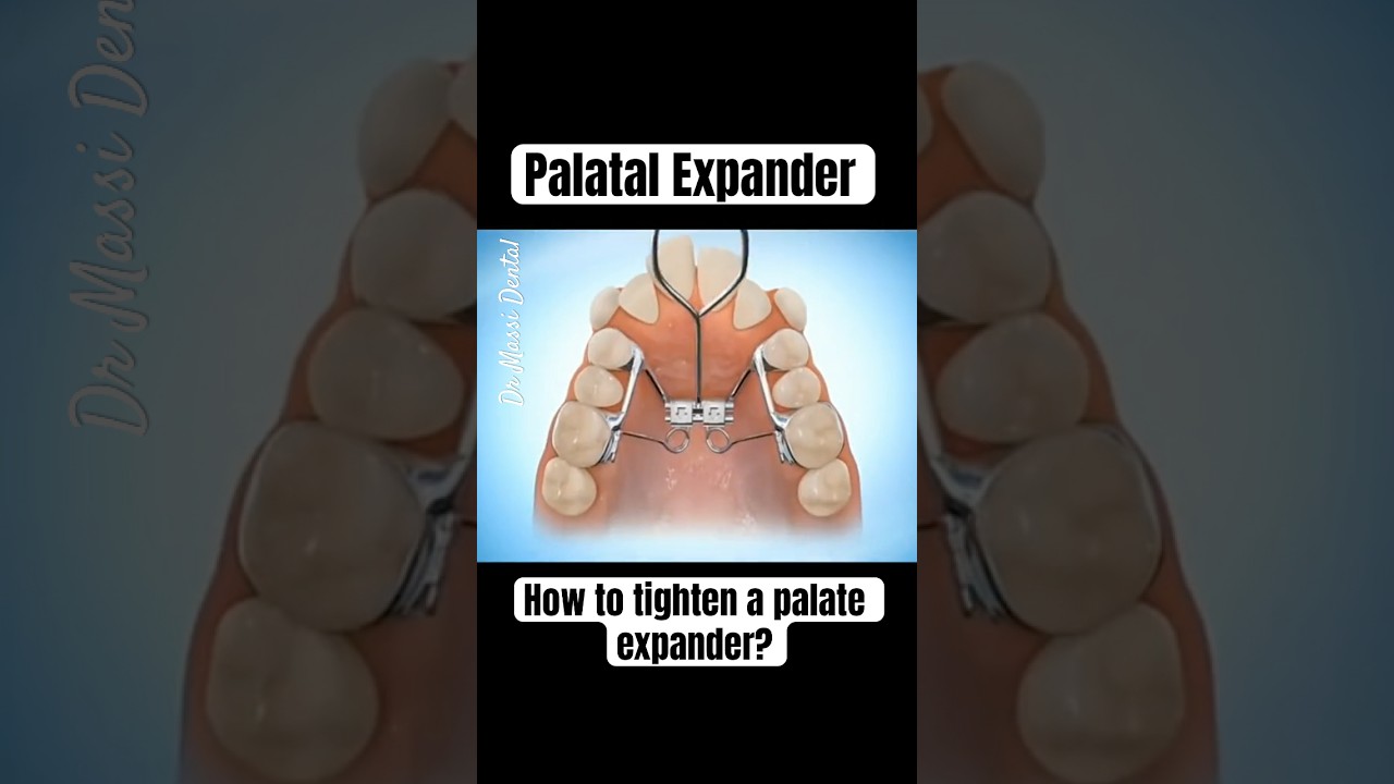How to tighten a palate expander?