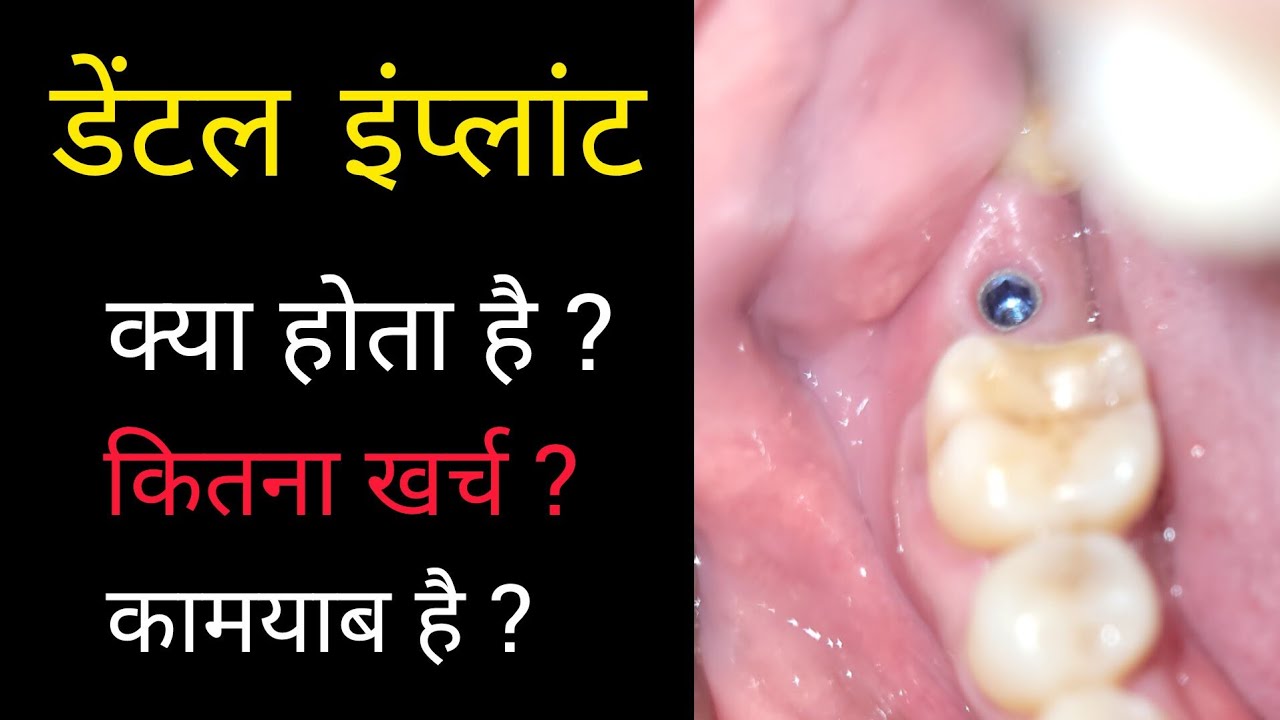 डेंटल इंप्लांट करवाने से पहले !#centerofdentaltreatment #dentalimplant 