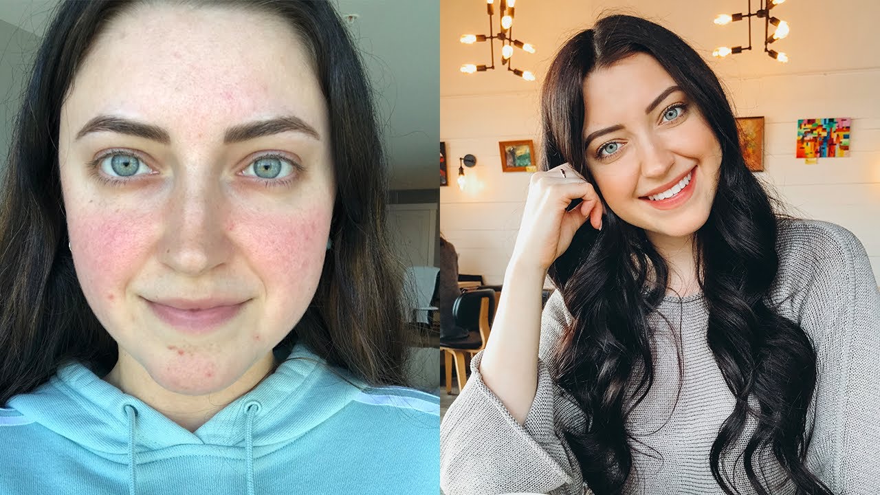 Treating Rosacea: my IPL experience