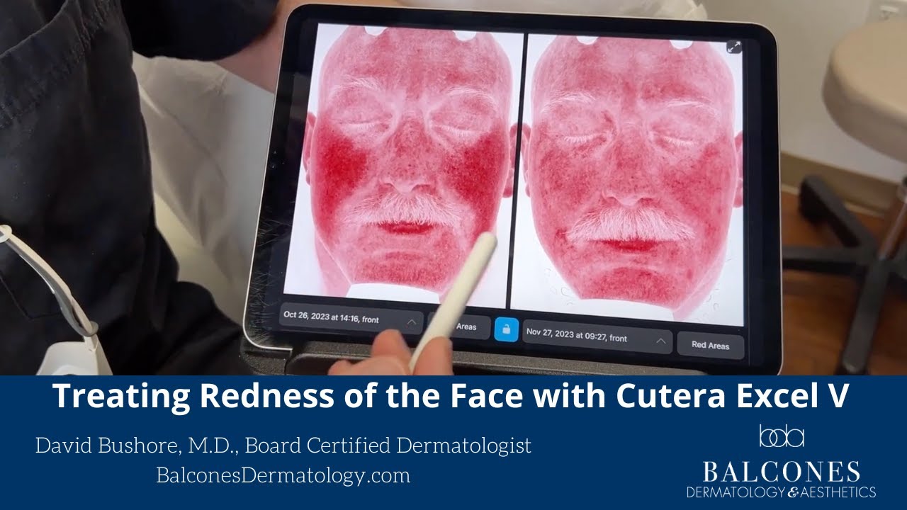 Treating Redness of the Face with Cutera Excel V | David Bushore, MD, FAAD| Ph: 512-459-4869