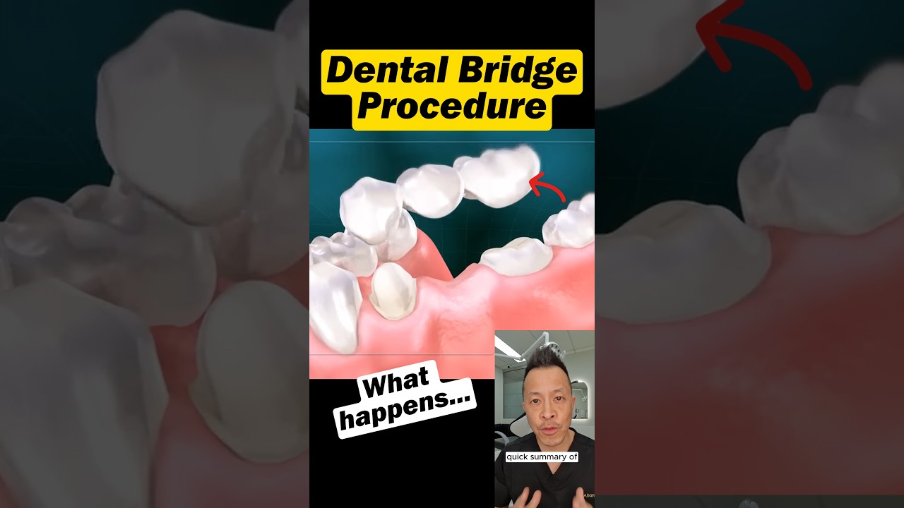 Missing a Tooth? Here&rsquo;s How a Dental Bridge Is Done #dentallan #dentist #shorts