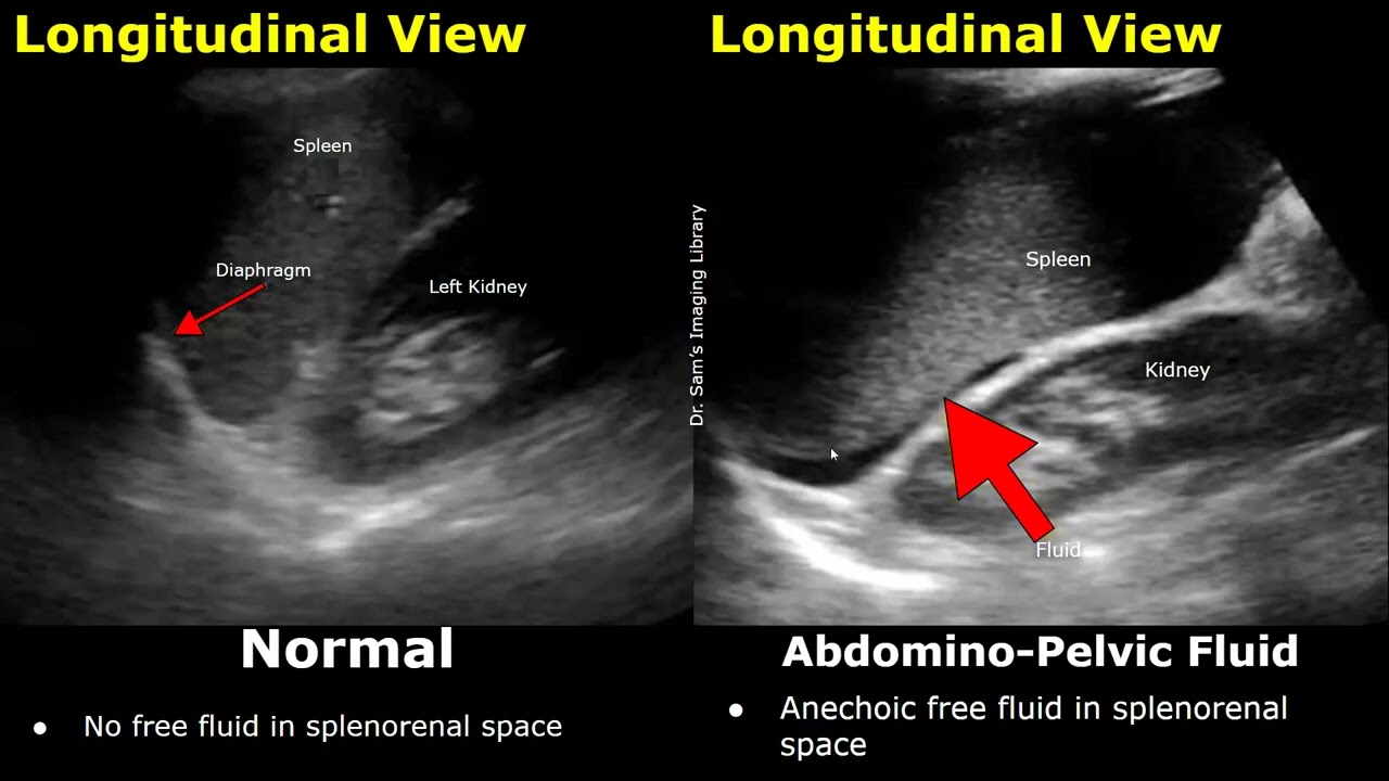 FAST Ultrasound Scan Normal Vs Abnormal Images | Focused Assessment With Sonography For Trauma USG