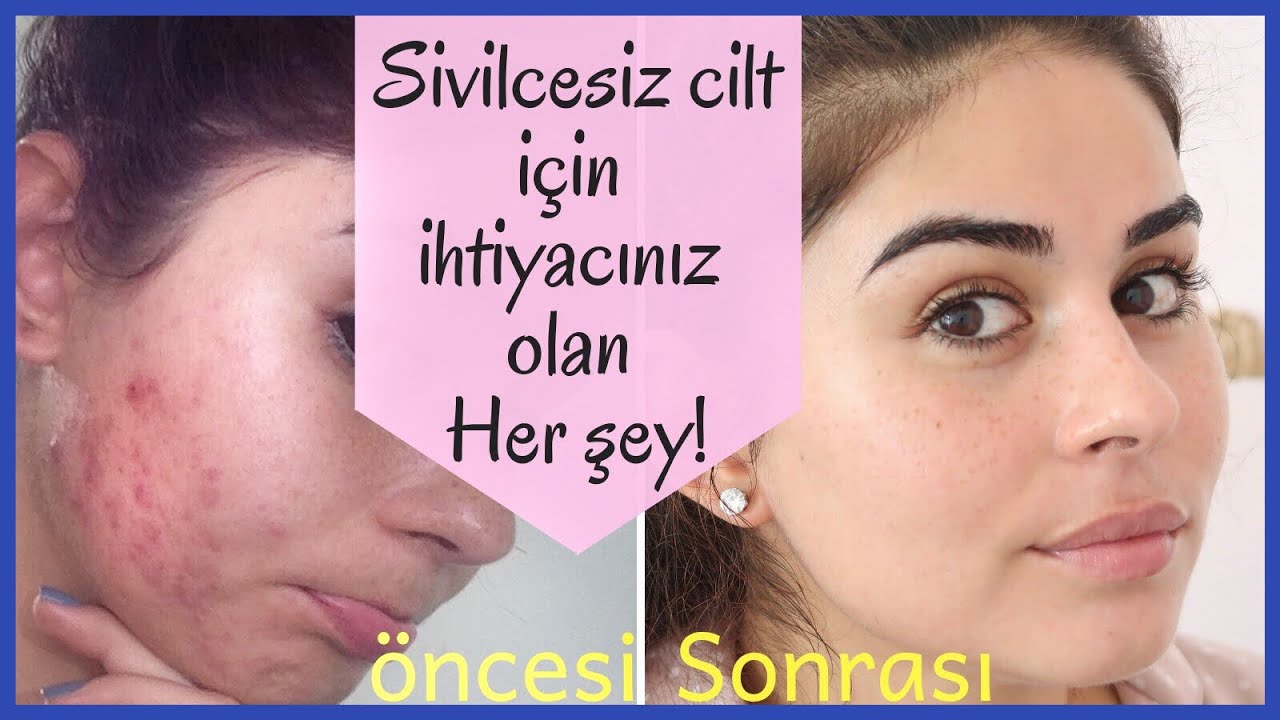 SİVİLCELERDEN NASIL KURTULDUM ? Hormonal akne, Beslenme , Besin takviyeleri