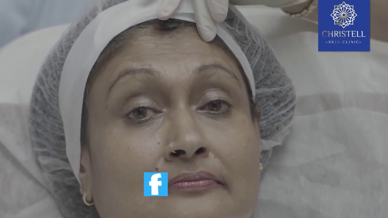 BOTOX treatment by Dr.Shanika Arsecularatne at Christell Skin Clinic