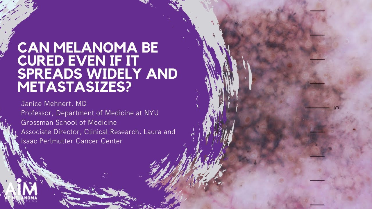 Can Melanoma Be Cured Even If It Spreads Widely and Metastasizes?