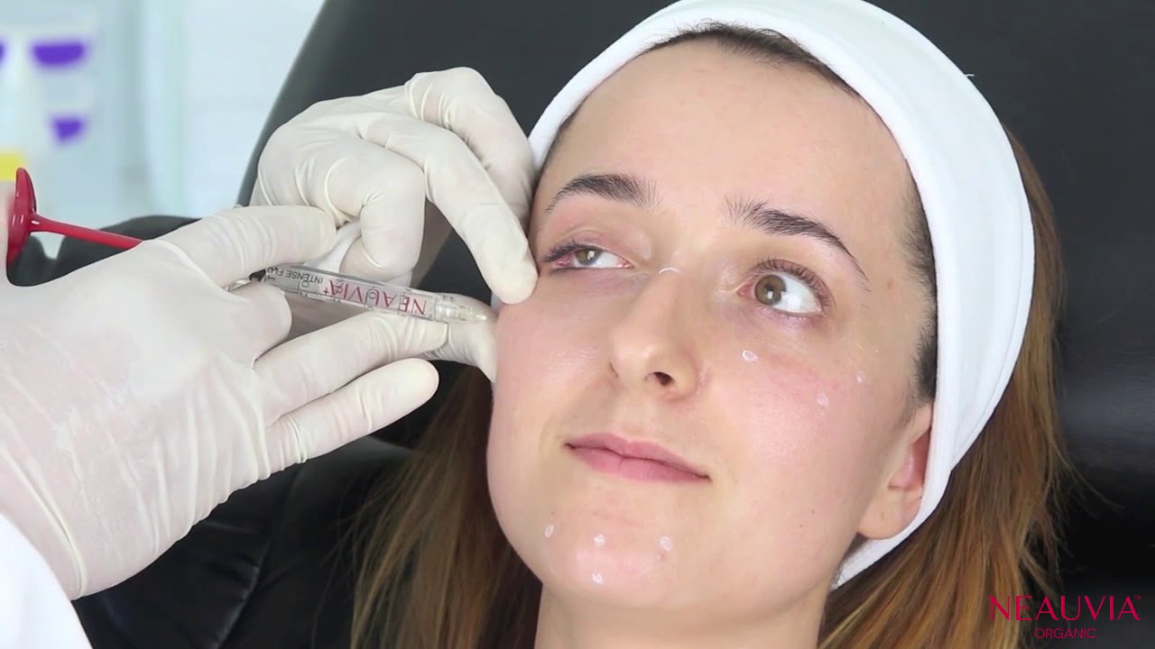 Neauvia Organic filler