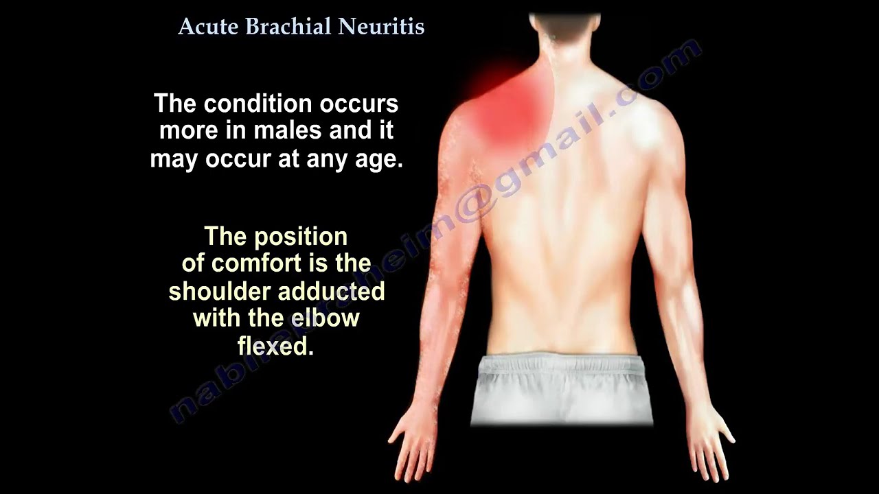 Brachial Neuritis – Parsonage-Turner Syndrome: Causes, Symptoms, and Recovery