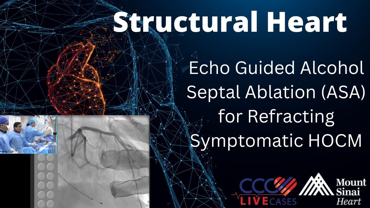 Echo Guided Alcohol Septal Ablation for Refracting Symptomatic HOCM Structural Heart Oct 2015 Video