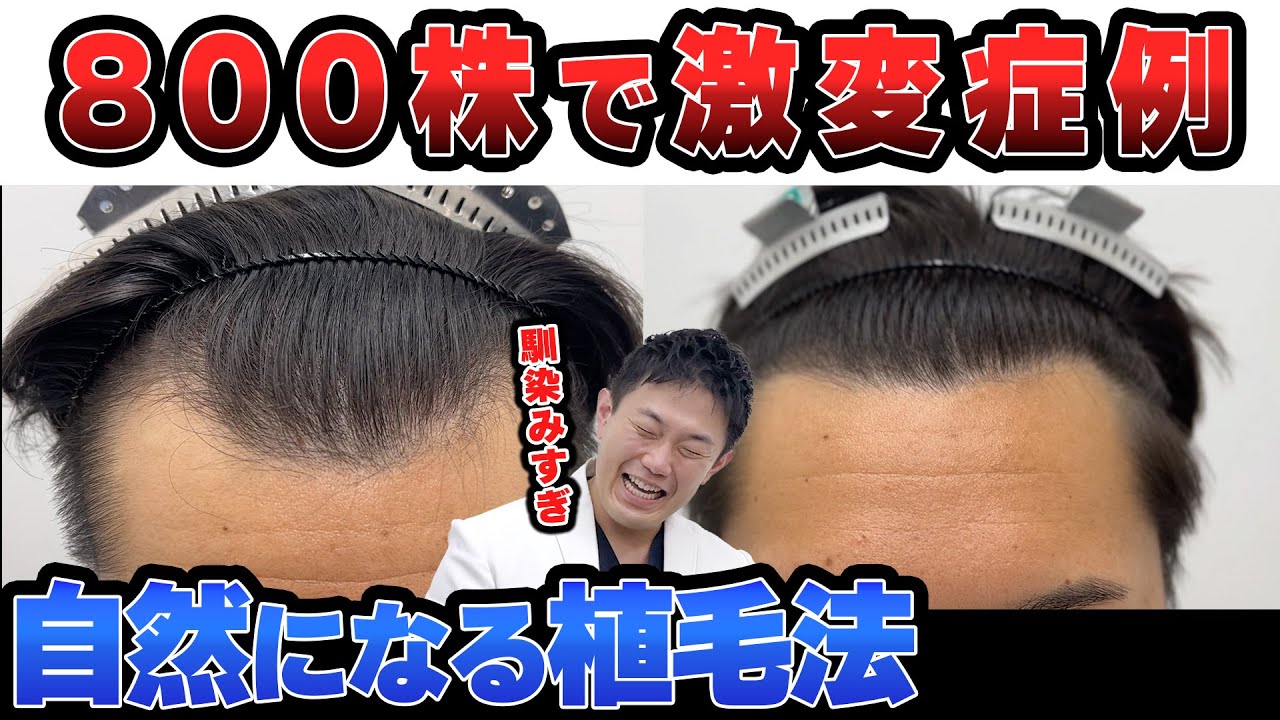 【映像付き】自毛植毛でM字が自然になったヤバすぎる症例経過を解説！
