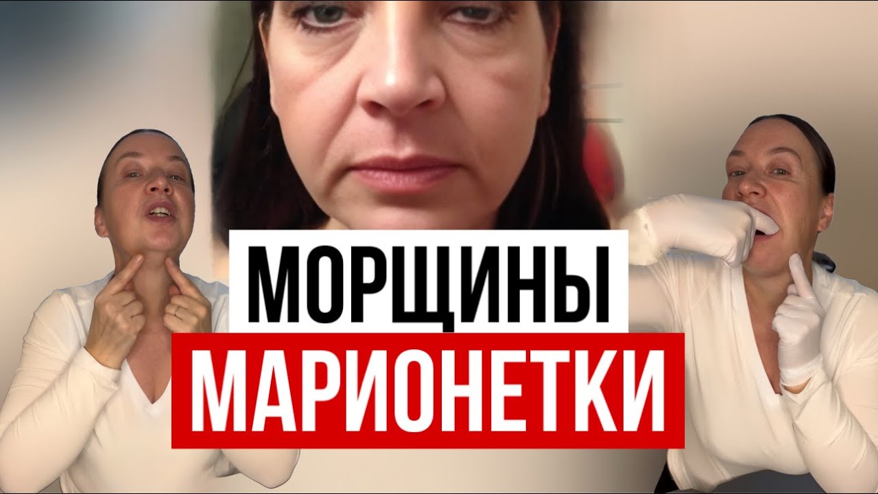 Убираем морщины марионетки. Быстро! 
